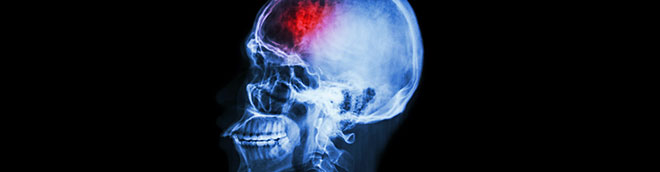 Limited-Time Offer for Stroke: Comprehensive Acute Stroke Care course